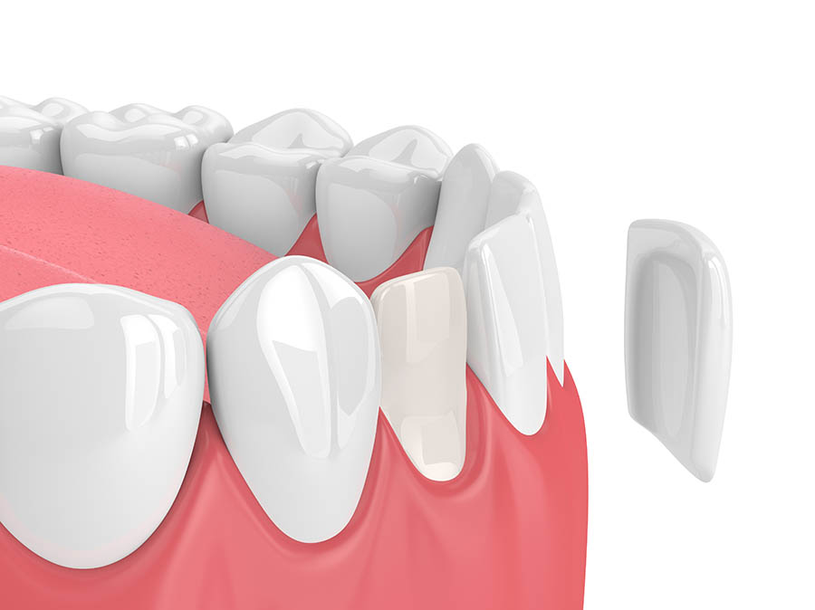 Porcelain veneers Richmond BC