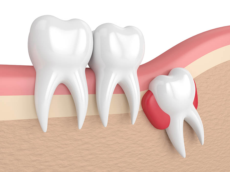 Richmond BC wisdom teeth extractions Richmond BC wisdom teeth extractions