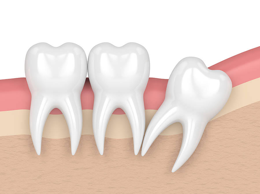 Richmond BC wisdom teeth impaction and extraction Richmond BC wisdom teeth impaction and extraction