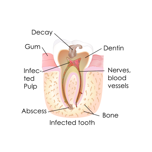 Infected tooth in need of a root canal