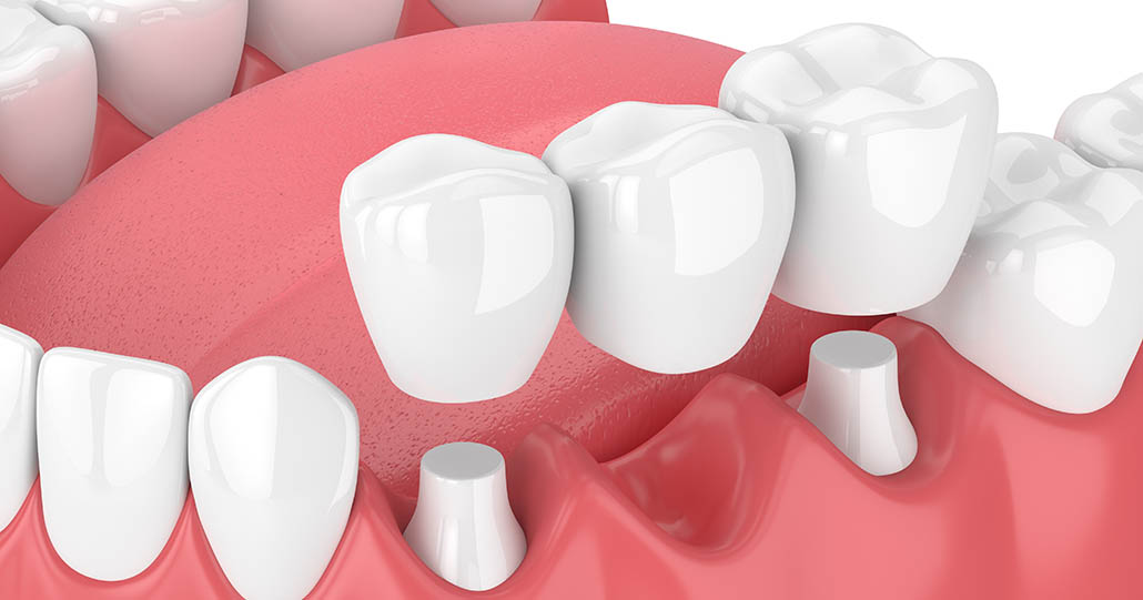 Dental bridges
