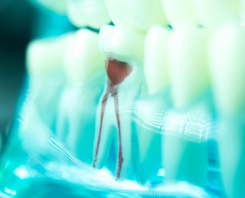 Root Canal