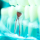 Root Canal