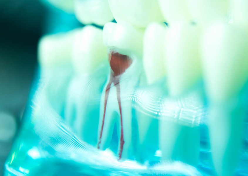 Root Canal