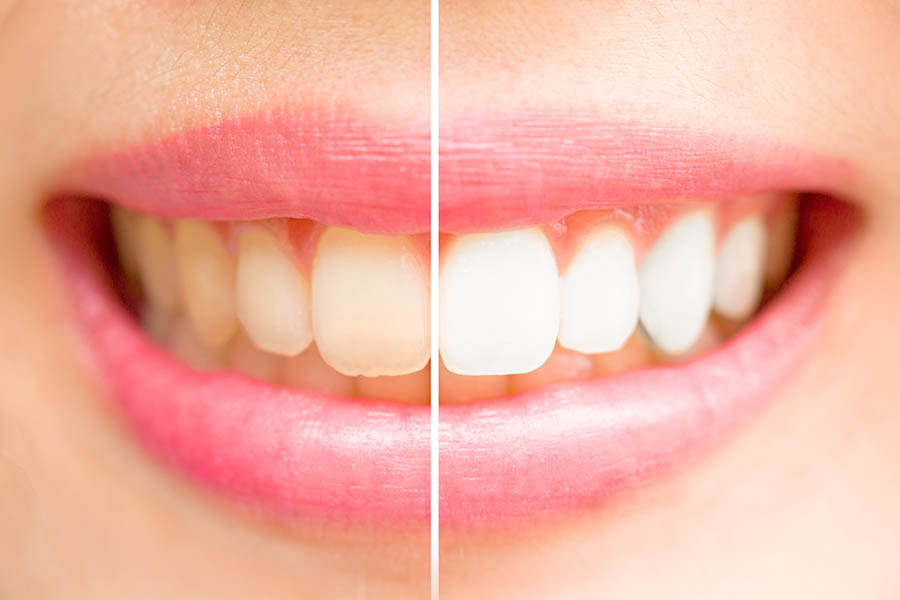 Richmond dentist teeth whitening before & after