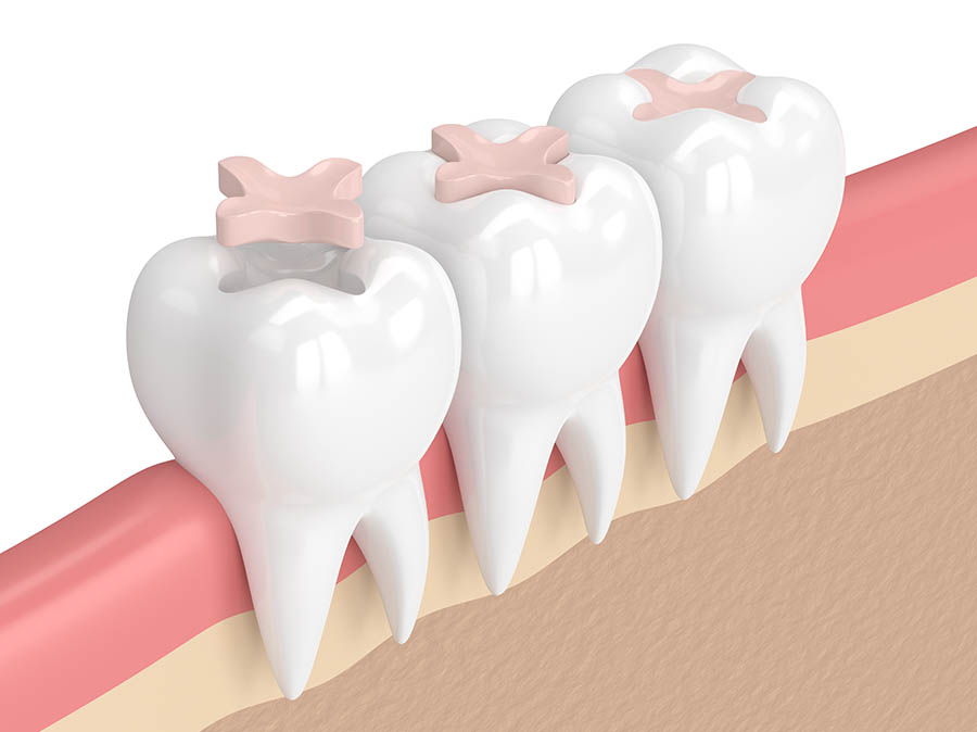 Porcelain Inlays / Onlays - Richmond Dentist Dr. Robert Oliveros DMD