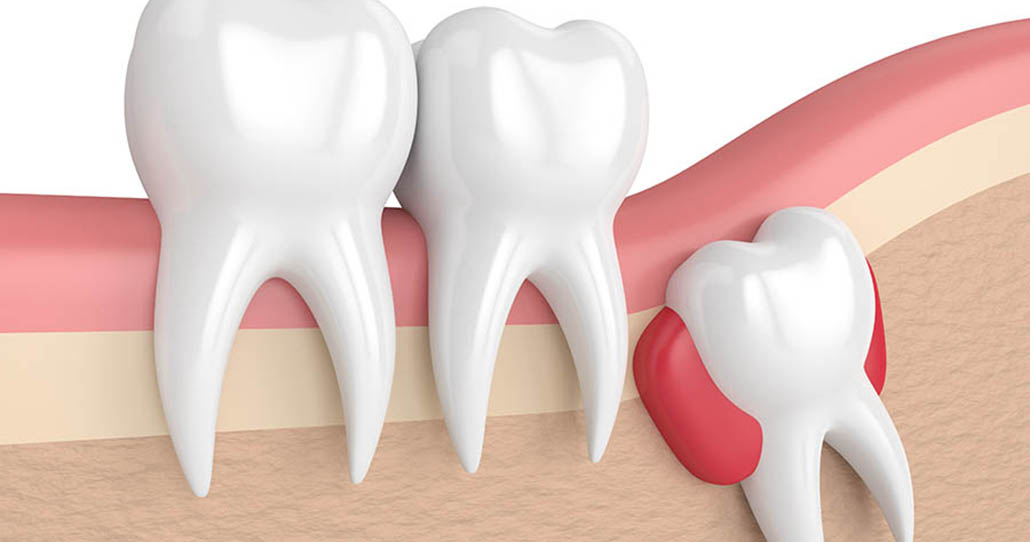 Wisdom teeth extraction