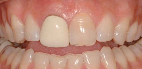 Crown - Before