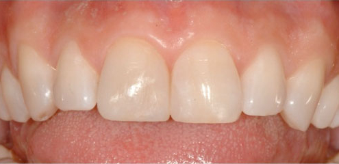 Crown - After