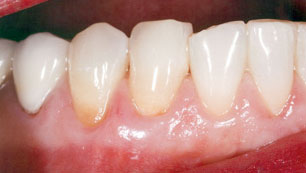 Gum disease - After