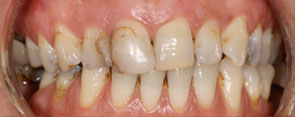 Porcelain Veneers - Before