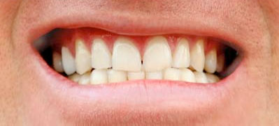 Teeth whitening - After